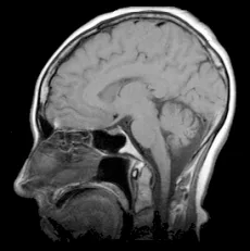 Mozog v MRI